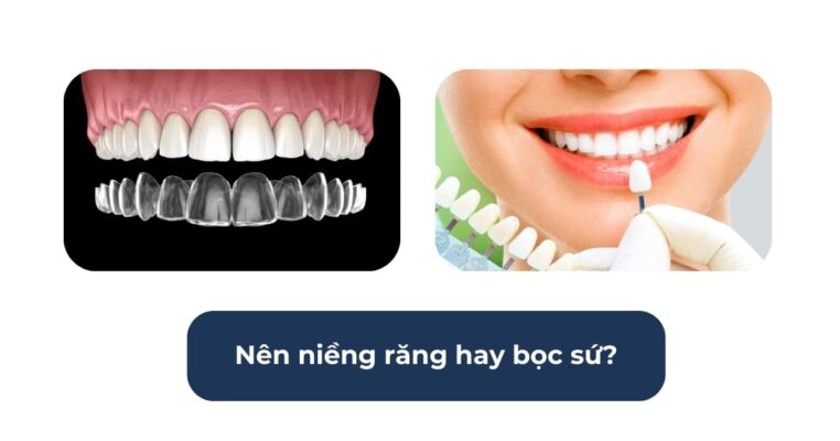 nên niềng răng hay bọc sứ