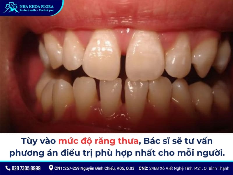 nên niềng răng hay bọc sứ