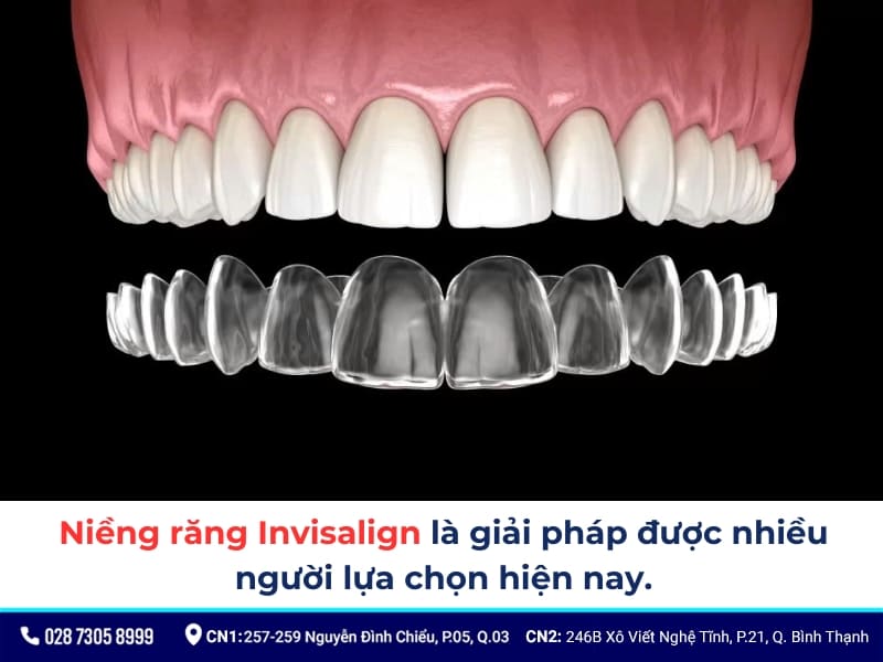 nên niềng răng hay bọc sứ