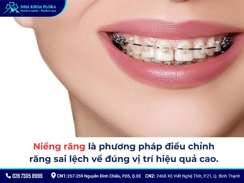 nên niềng răng hay bọc sứ