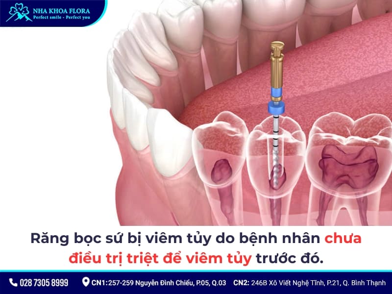 răng bọc sứ bị viêm tủy