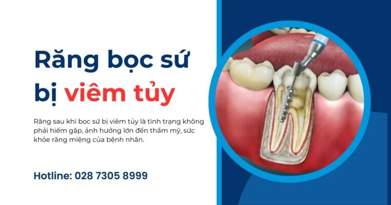 răng bọc sứ bị viêm tủy