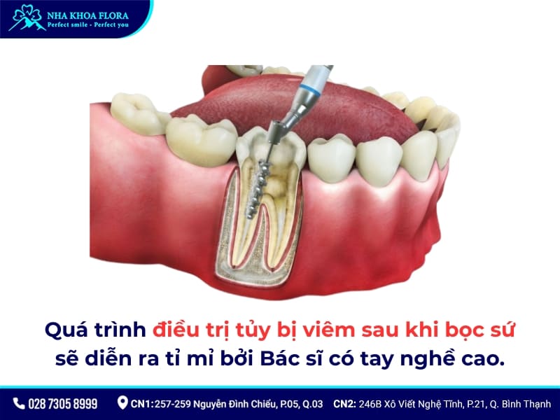 răng bọc sứ bị viêm tủy