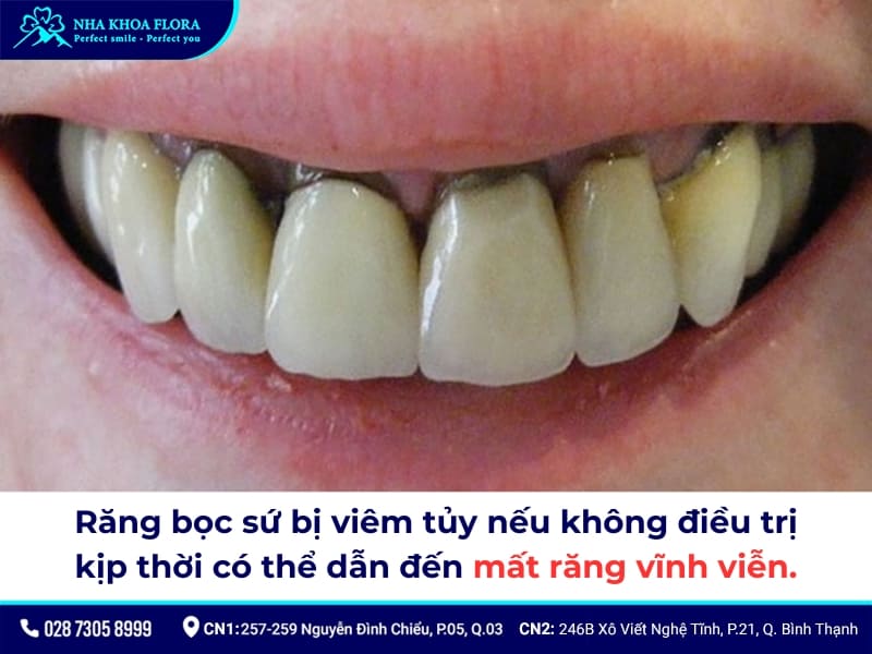 răng bọc sứ bị viêm tủy