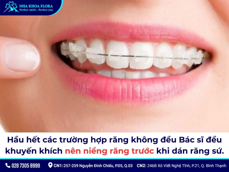 răng không đều có dán sứ được không