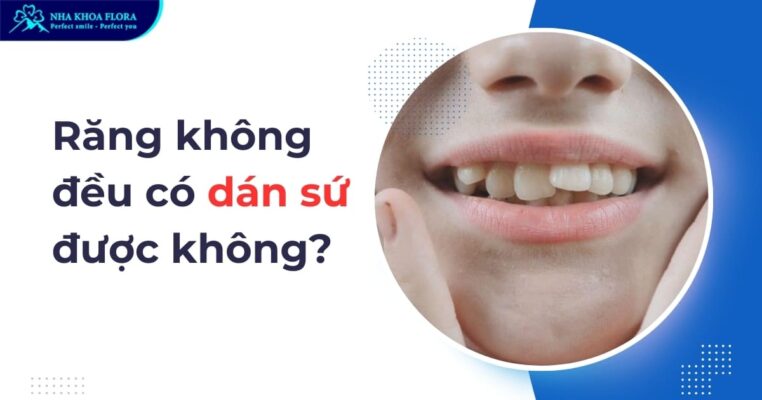 răng không đều có dán sứ được không
