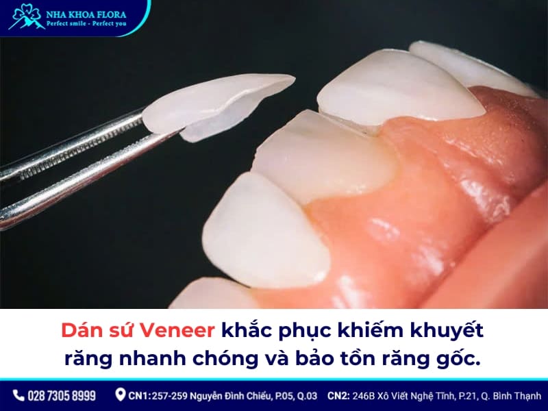 răng sâu có dán sứ được không