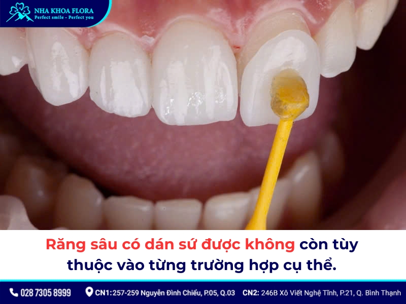 răng sâu có dán sứ được không