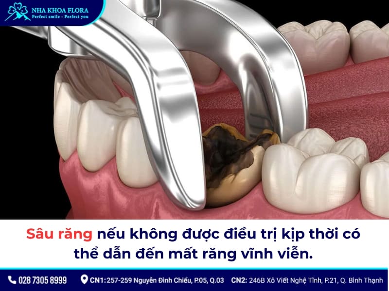 răng sâu có dán sứ được không