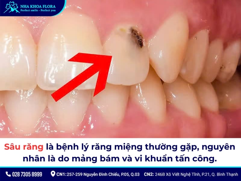 răng sâu có dán sứ được không