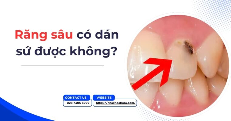 răng sâu có dán sứ được không