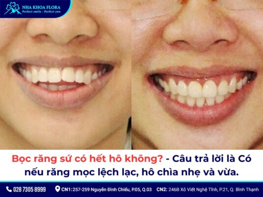 Bọc răng sứ có hết hô không? - ảnh 1