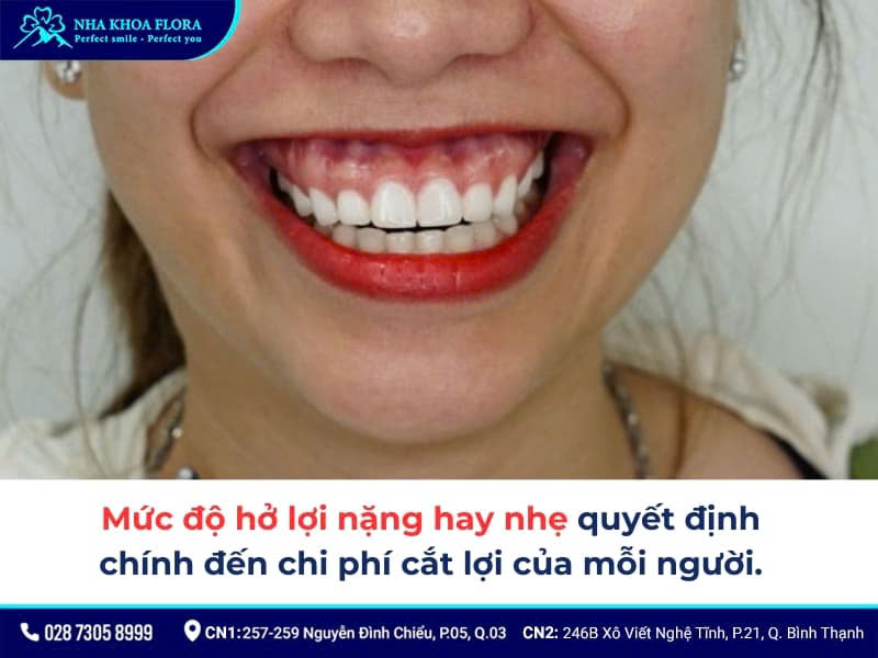 chi phí cắt lợi