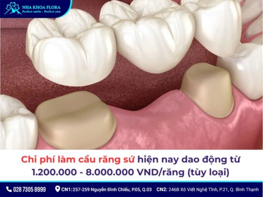 Chi phí làm cầu răng sứ - ảnh 1
