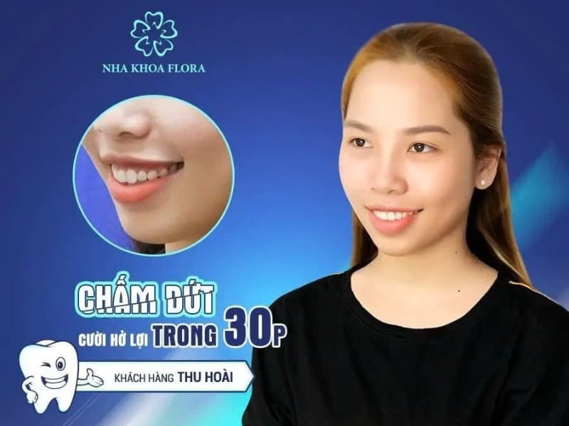 cười hở lợi