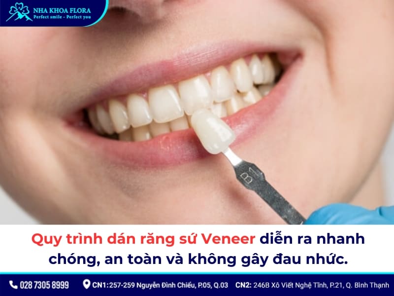 dán sứ veneer