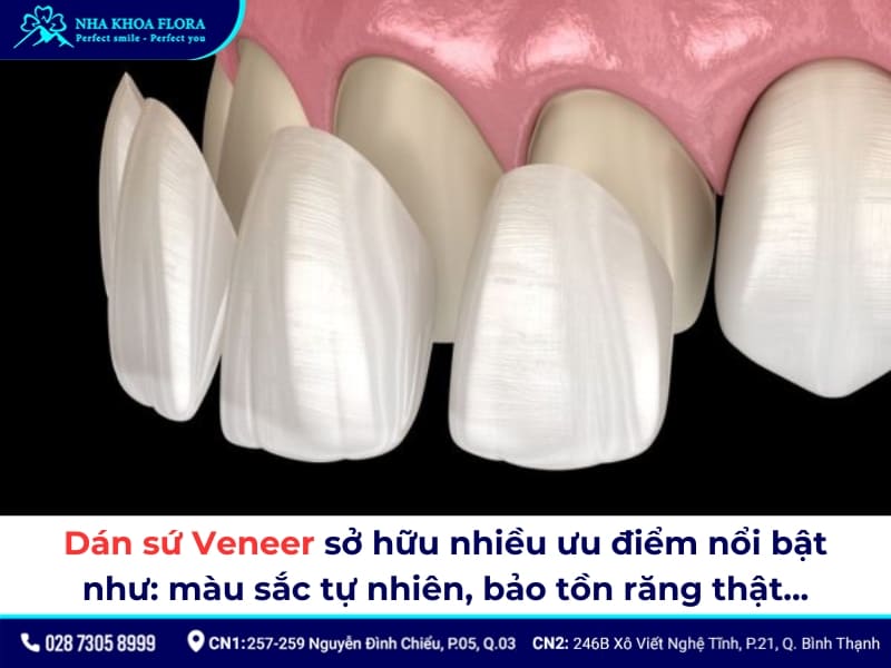 dán sứ veneer
