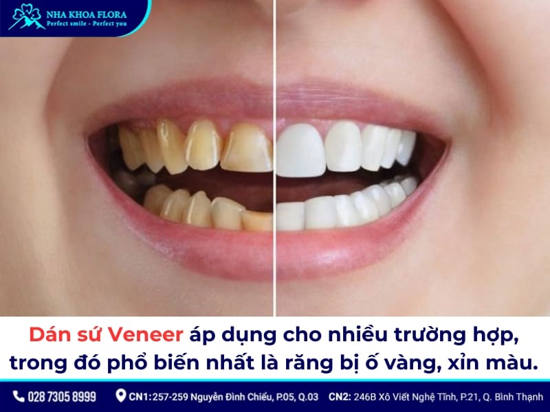 dán sứ veneer