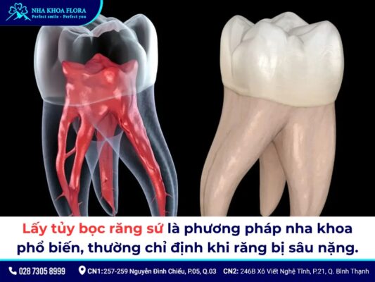 Lấy tủy bọc răng sứ mất bao lâu? Quy trình, giá bao nhiêu? 1