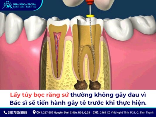 Lấy tủy bọc răng sứ mất bao lâu? Quy trình, giá bao nhiêu? 2