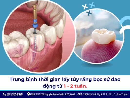 Lấy tủy bọc răng sứ mất bao lâu? Quy trình, giá bao nhiêu? 4