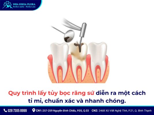 Lấy tủy bọc răng sứ mất bao lâu? Quy trình, giá bao nhiêu? 5