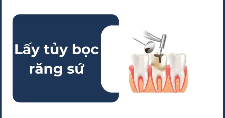 Lấy tủy bọc răng sứ