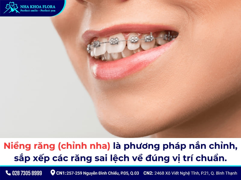 niềng răng