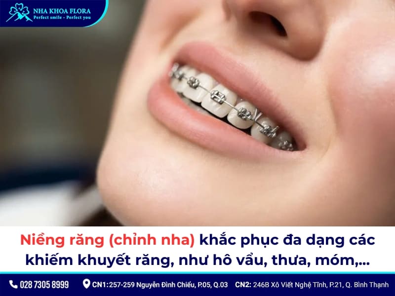 niềng răng