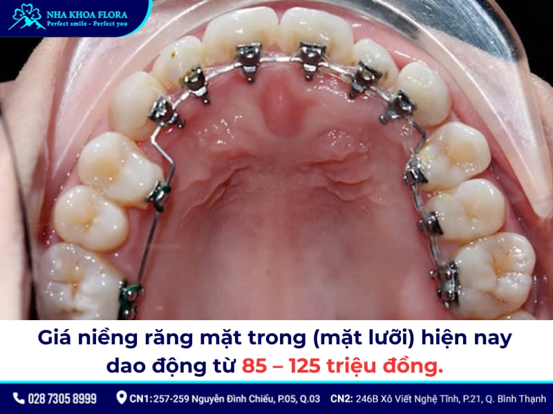 niềng răng bao nhiêu tiền