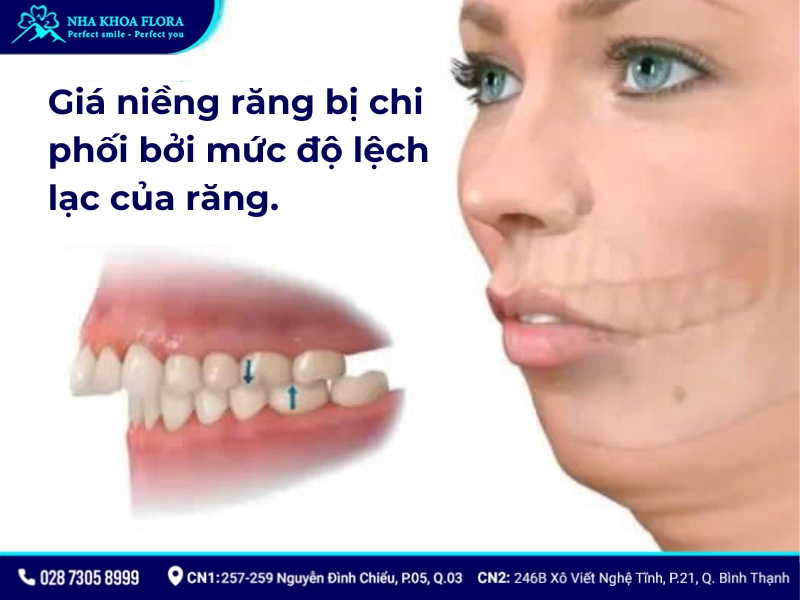 niềng răng bao nhiêu tiền