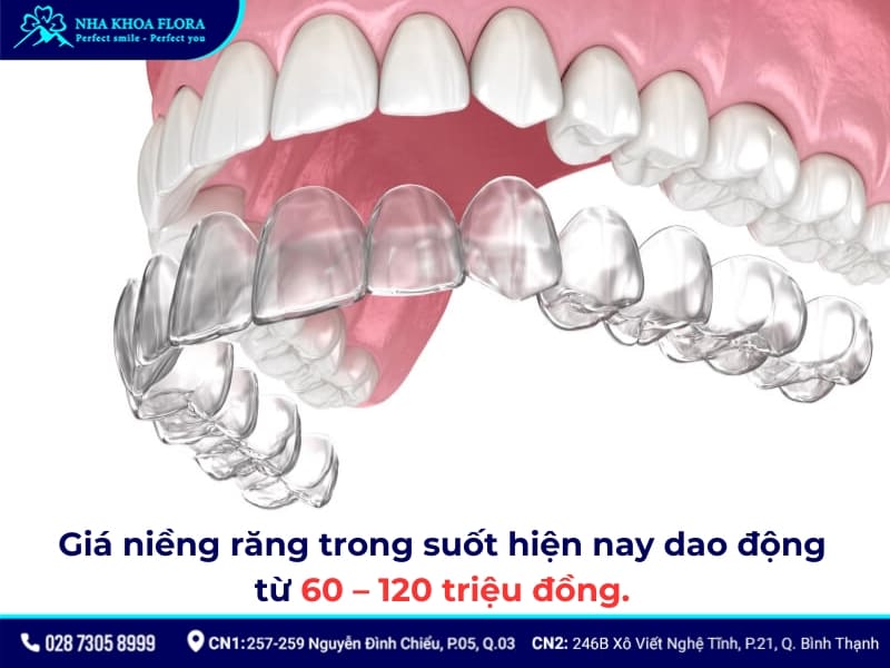 niềng răng bao nhiêu tiền