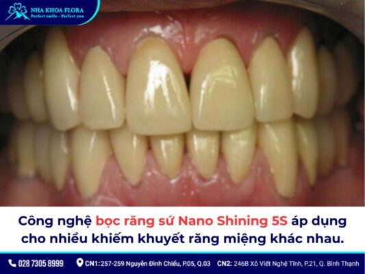 Răng sứ Nano Shining 5S giá bao nhiêu - ảnh 3
