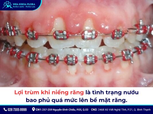 lợi trùm khi niềng răng - ảnh 1