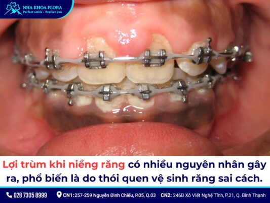 lợi trùm khi niềng răng - ảnh 2