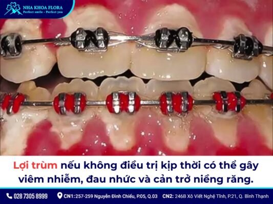 lợi trùm khi niềng răng - ảnh 3