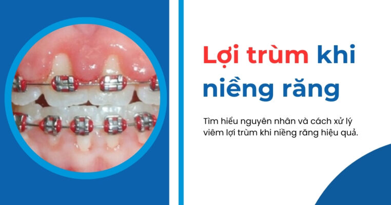 lợi trùm khi niềng răng