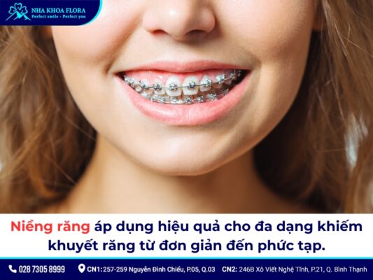 niềng răng - ảnh 2