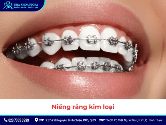 niềng răng - ảnh 4
