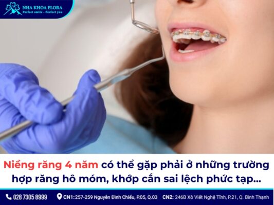 niềng răng 4 năm - ảnh 1