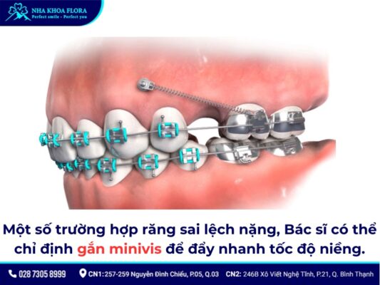 niềng răng 4 năm - ảnh 5