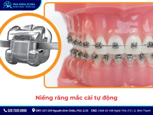 niềng răng - ảnh 6