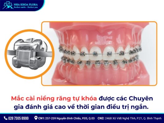 niềng răng bao lâu thì hết đau - ảnh 3