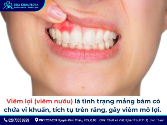 niềng răng bị sưng lợi - ảnh 1