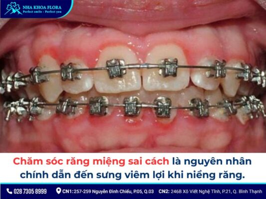 niềng răng bị sưng lợi - ảnh 2