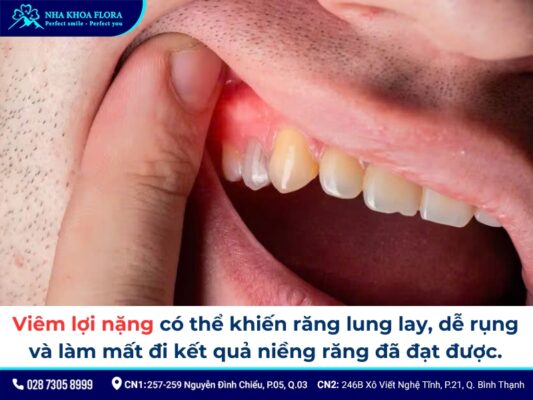 niềng răng bị sưng lợi - ảnh 5