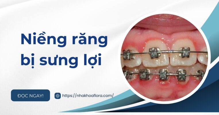 niềng răng bị sưng lợi