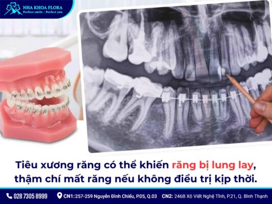 niềng răng bị tiêu xương - ảnh 3