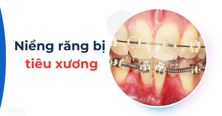 niềng răng bị tiêu xương