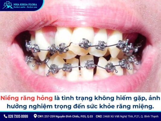 niềng răng hỏng - ảnh 1 niềng răng hỏng - ảnh 1